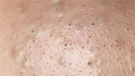 Back Blackheads Galore .